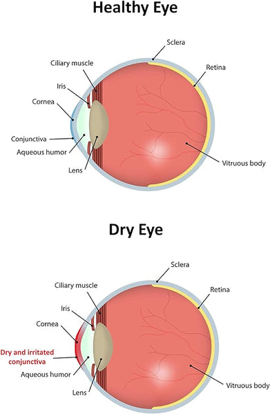 An illustration compares a healthy eye and a dry eye, highlighting normal anatomy versus inflamed conjunctiva. Labels identify parts like sclera, retina, and cornea. Using Vizulize Dry Eyes Eye Drops (10ml) can provide relief for dry eyes in such conditions.